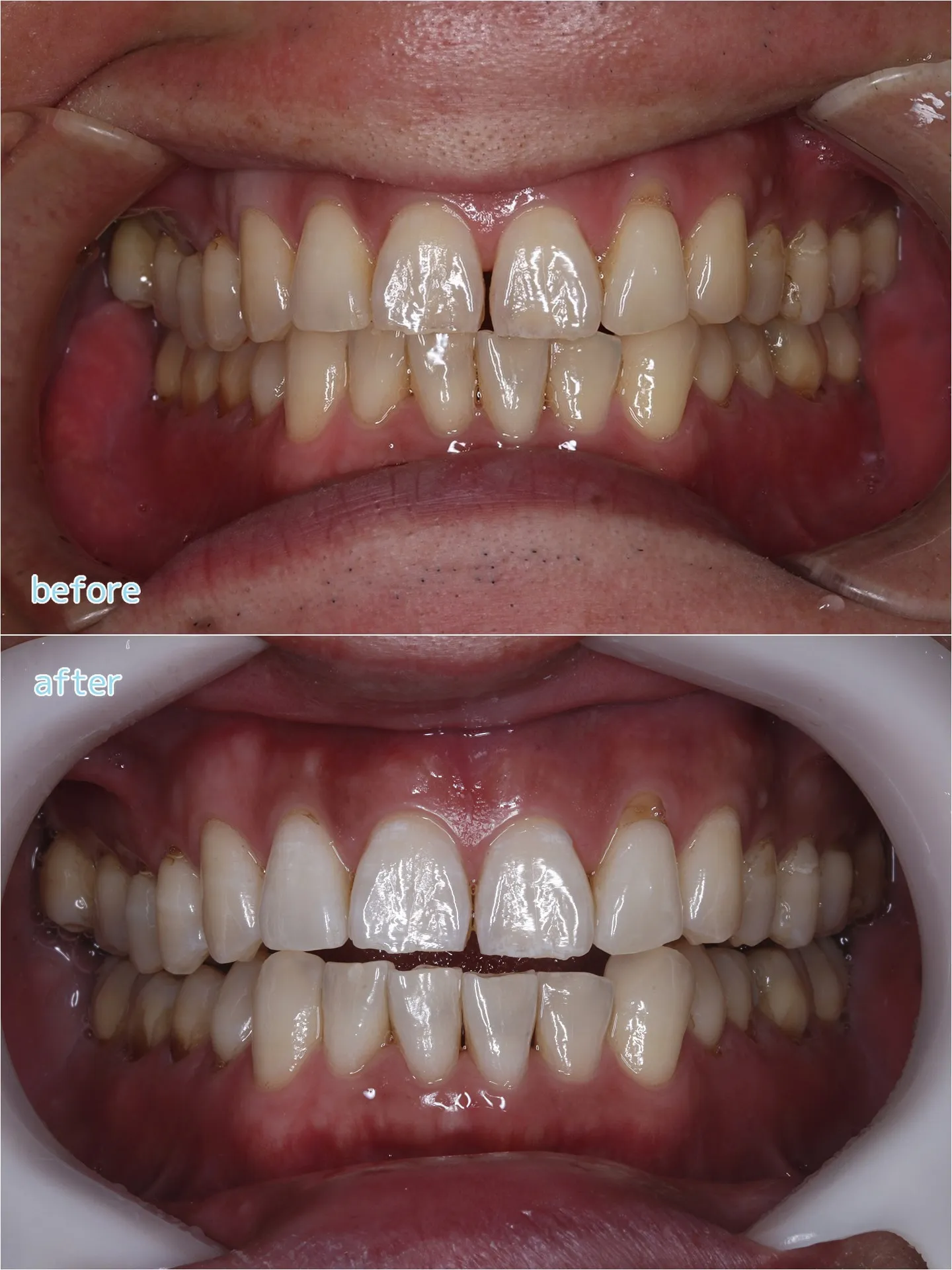 こんにちは😊おちデンタルクリニック長久手です🧚🏻